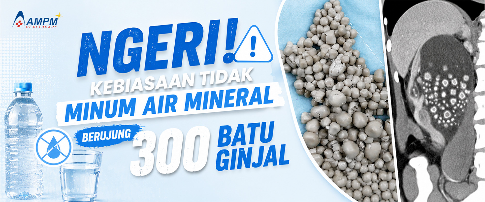 NGERI! Lebih dari 300 Batu Ginjal di Temukan Karena Kebiasaan Tidak Minum Air Putih